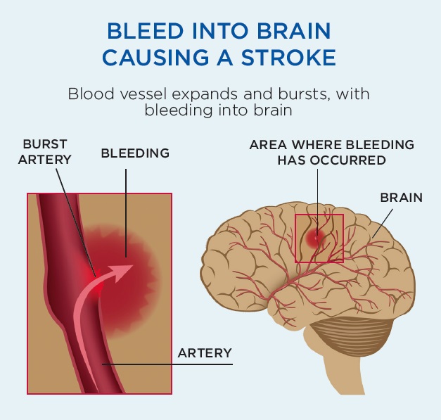 what-is-a-stroke-stroke-foundation-nz